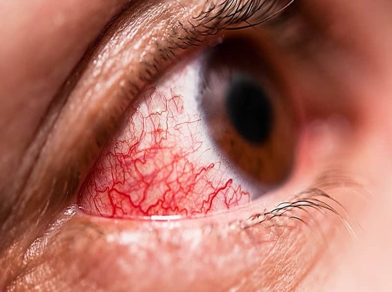 Causes-of-conjunctivitis