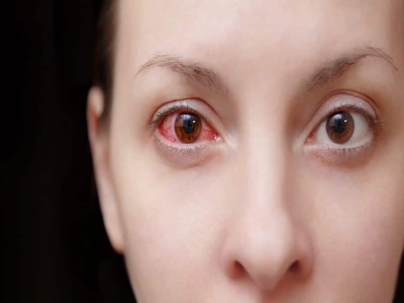 pink_eye_eye_flu_or_conjunctivitis_treatment